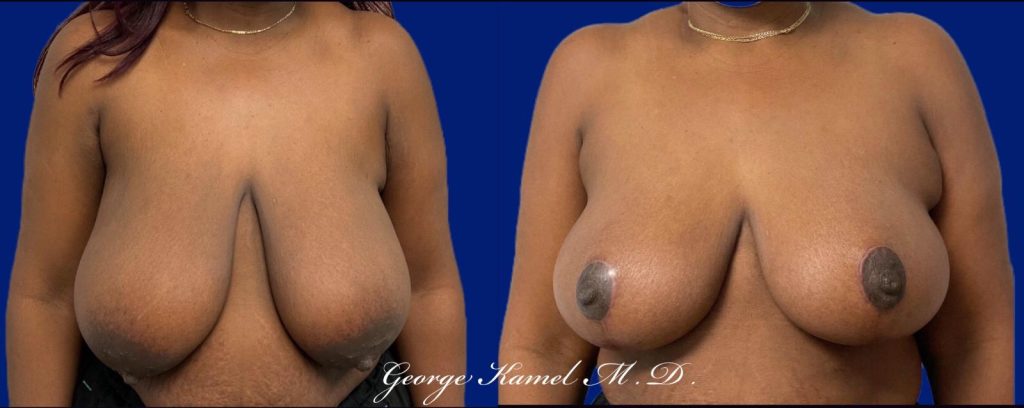 Before and after images of a breast reduction surgery on a person with dark skin, set against a blue background.