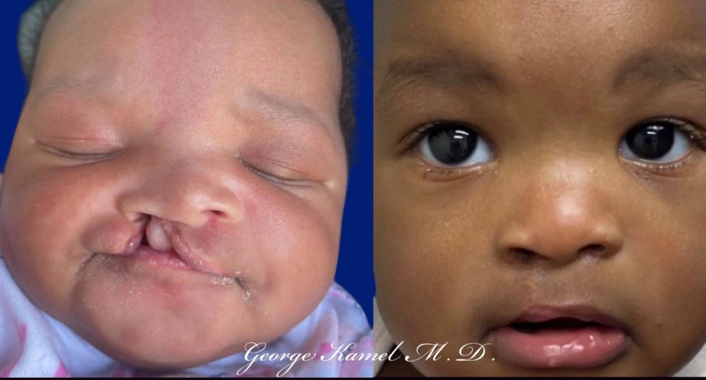 Side-by-side images of a child: on the left, with a cleft lip and palate; on the right, after surgical repair.