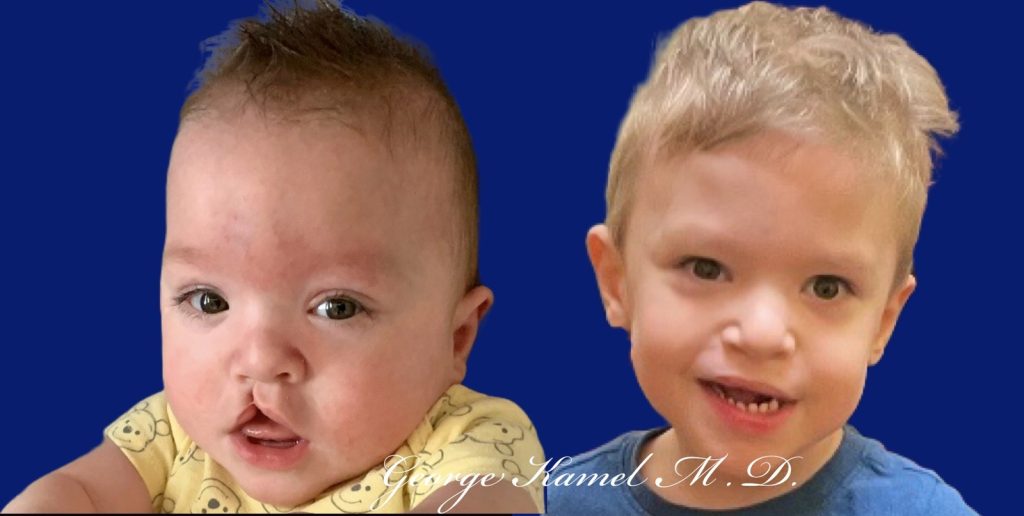 Two young children against a blue background, one with a cleft lip, both wearing casual outfits. Text overlaid at the bottom.