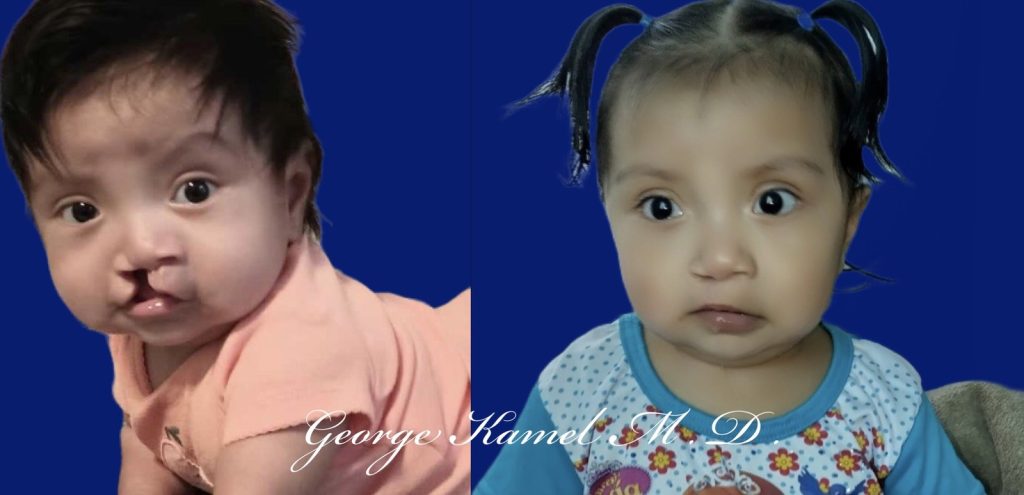 Two images of a young child side by side. On the left, the child has a cleft lip. On the right, the child appears after corrective surgery. Blue background in both images.