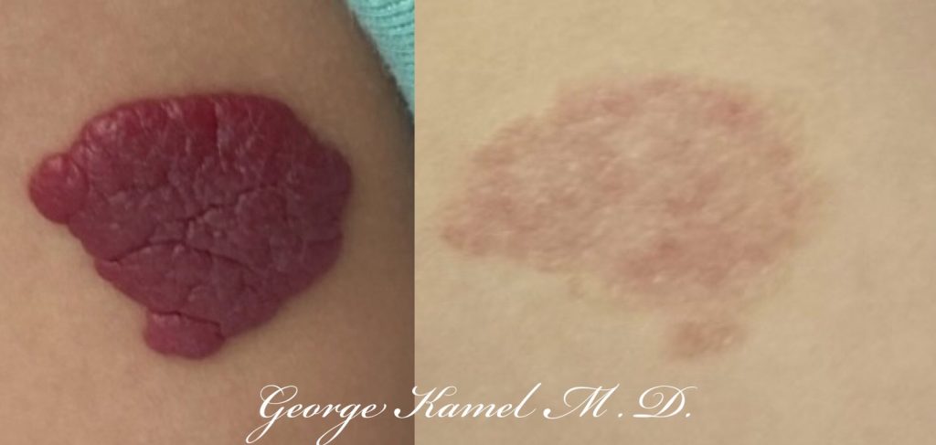 Side-by-side comparison of a skin condition, with a dark, textured patch on the left and a faded, smoother patch on the right.