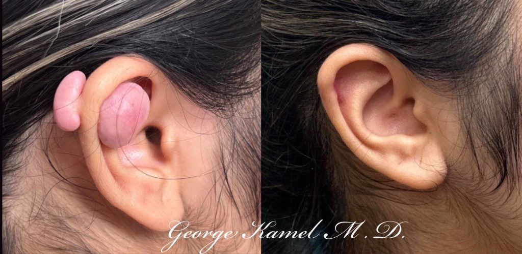 Side-by-side images showing an ear with a large keloid on the left and the same ear without the keloid on the right.