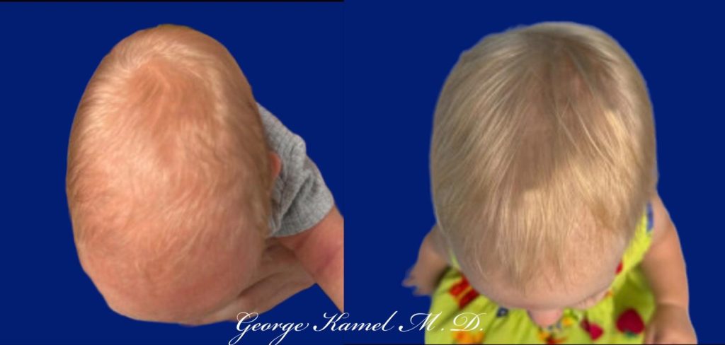 Two top-down images of a child's head, before and after hair growth treatment. The first image shows thinner hair, while the second shows thicker hair.