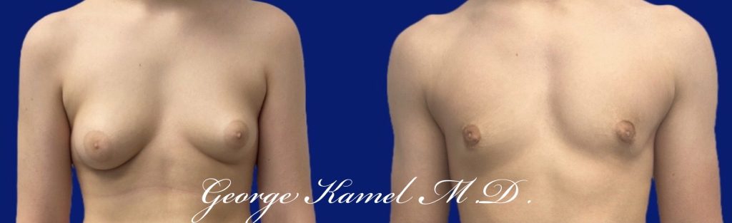 Before and after images showing a person's chest, with visible changes between the two photos.