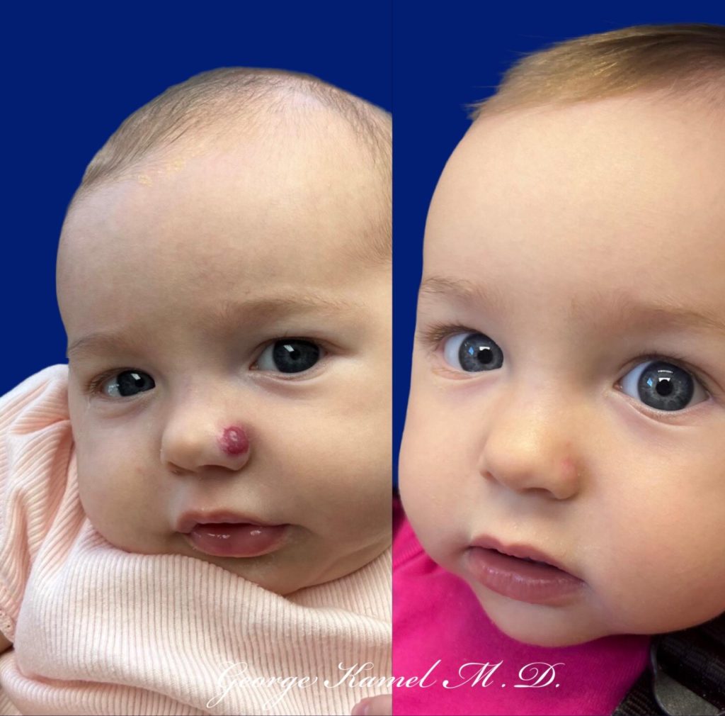 Two side-by-side images of a baby. Left: a pink bump on the nose. Right: bump reduced in size. Blue background.
