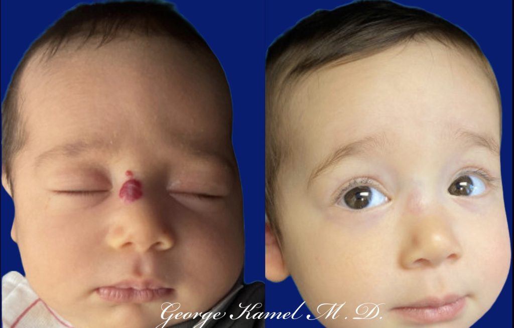 Close-up of a child's face before and after hemangioma removal, showing the transformation from a raised red mark on the forehead to clear skin.
