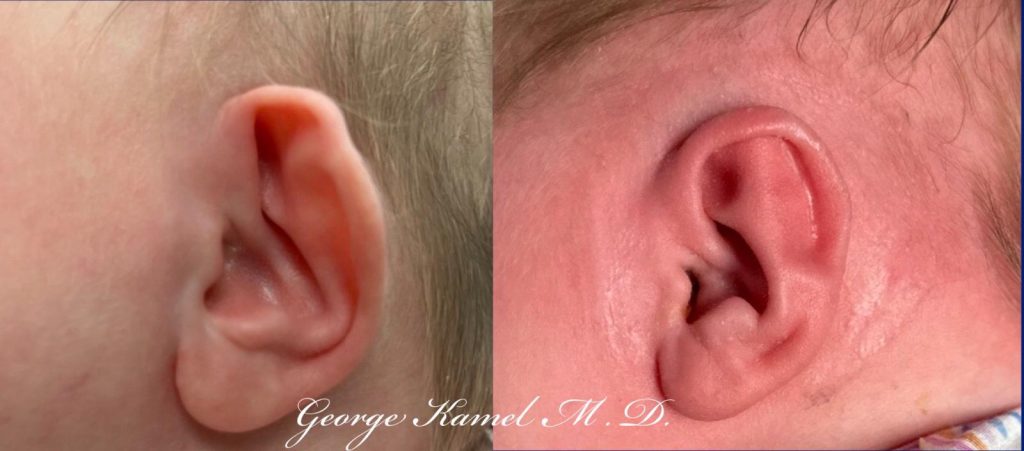 Close-up of a baby's ear showing before and after surgical correction.