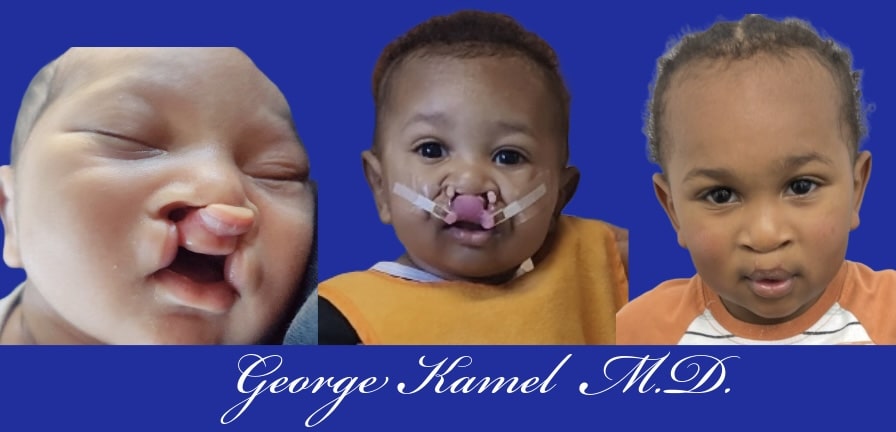 Three images show the progression of a child's cleft lip and palate repair. The first image features an unrepaired cleft, the second shows post-surgery with tape, and the third displays a healed result.