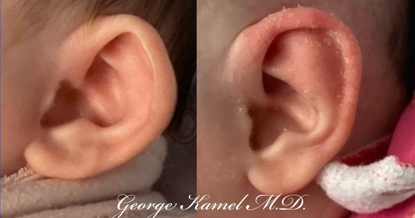 Close-up image comparing two ears, showcasing different ear shapes.