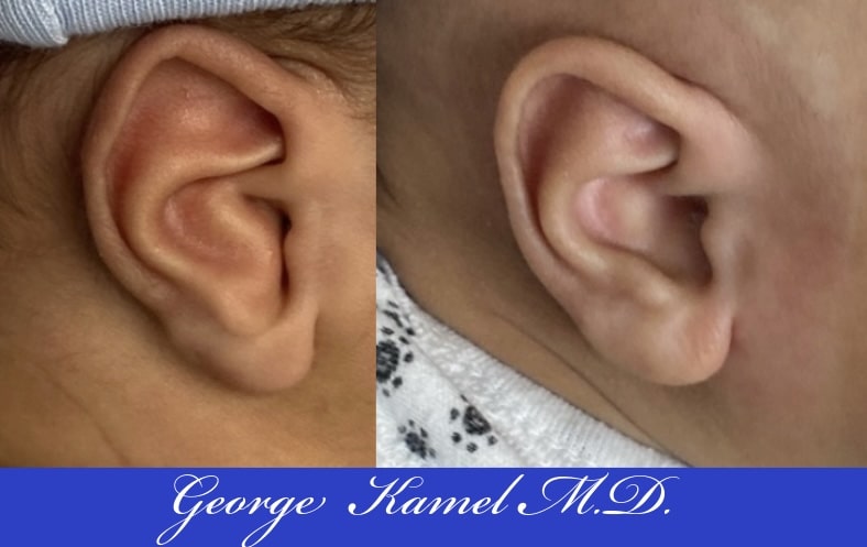 Close-up of two ears side by side showing slight differences in shape and size. The background is blue with text saying "George Kamel M.D.