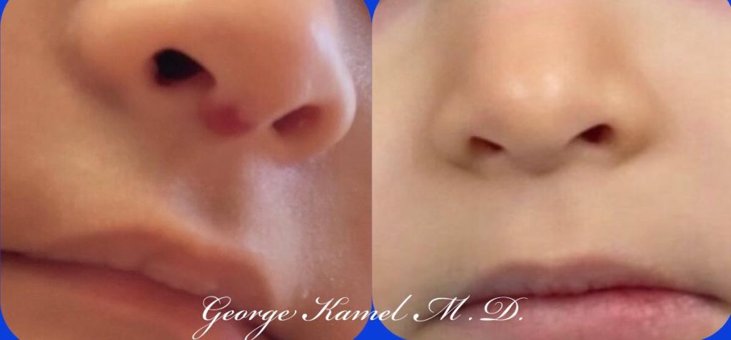 Close-up of two side-by-side nose and mouth selfies, showcasing differences before and after a procedure. The left image shows a slight bump; the right image appears smoother.