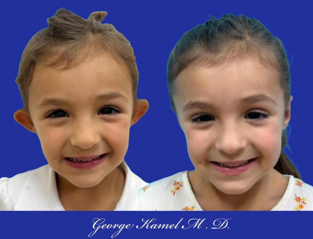Two side-by-side images of a young child with brown hair against a blue background, showing before and after views with ears prominently visible on the left and appearing more aligned on the right.