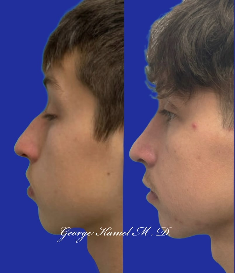 Side-by-side profile view photographs show a person's face before and after a rhinoplasty procedure.