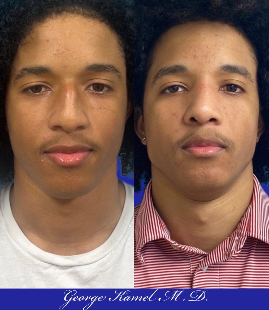 Two side-by-side images of the same young person with curly hair, wearing a white shirt in the first and a red striped shirt in the second.