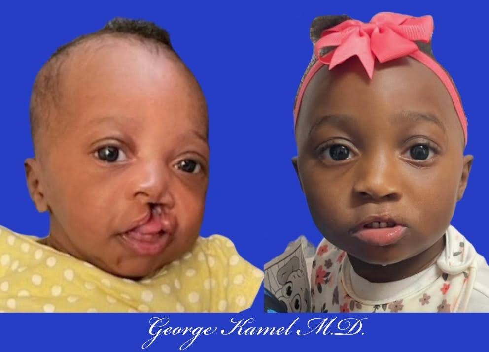 Side-by-side photos of a child before and after cleft lip surgery, wearing a yellow outfit on the left and a white one with a pink bow on the right. Blue background with white text.