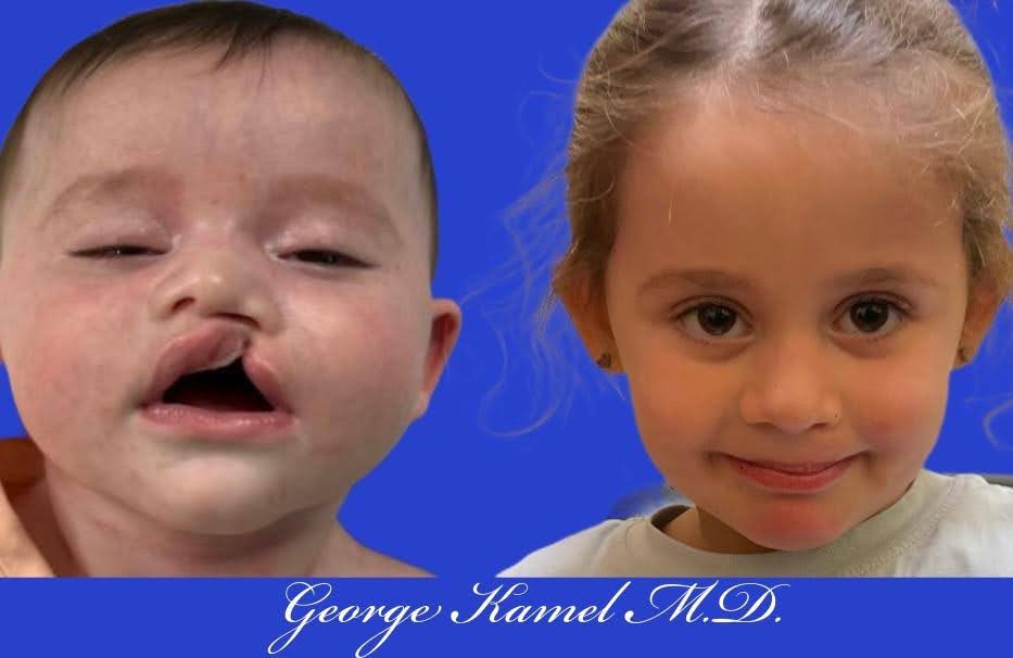 Side-by-side images showing a baby with a cleft lip and a young girl post-repair. Blue background with text at the bottom.